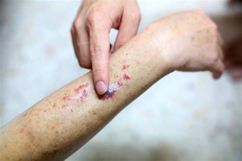 Spell marks on skin
